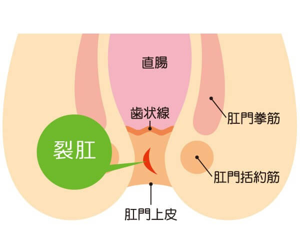 切れ痔（裂肛）について