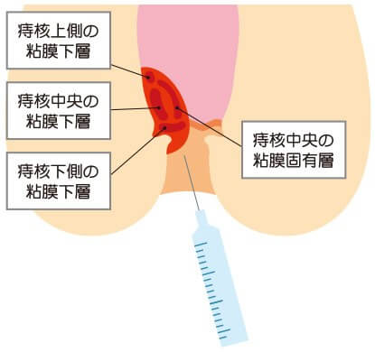 ALTA療法