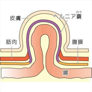 鼠径ヘルニアについて