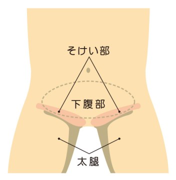 鼠径ヘルニアの症状